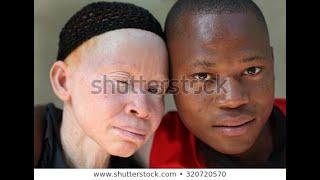 Albinism Disease | International Albinism Awareness Day | Albinism in Hindi | Albinism in India