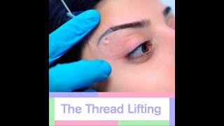 Would You Like To See How The Thread Lifting Is Done? @VanityCosmeticSurgery #ThreadLift