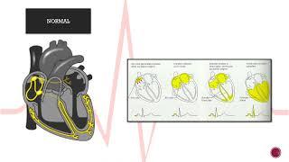 Bloqueos Cardiacos
