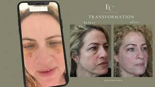 Video Diary of Recovery Process from Blepharoplasty Surgery: Day by Day