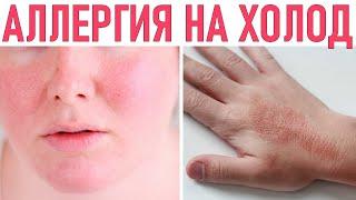 АЛЛЕРГИЯ НА ХОЛОД | Откуда берётся аллергия на холод и как с ней бороться