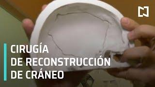 Cirugía de reconstrucción de Cráneo | Fractura de Cráneo - Las Noticias