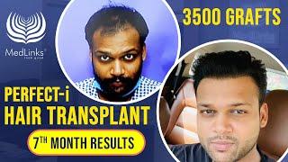 Hair Transplant Testimonial | Most trusted hair transplant clinic in India, Delhi | Medlinks