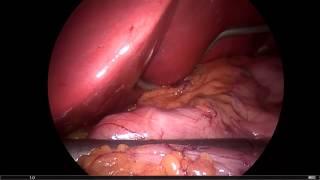 Tüp mide ameliyatı nasıl yapılır? Prof Dr Koray Tekin www.obezitecerrahimiz.com