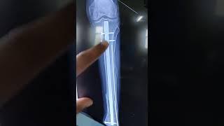 United Fracture Tibia with IMIL Nail in  situ..For Implant Removal ..Dr Sai Chandra MBBS DNB Ortho