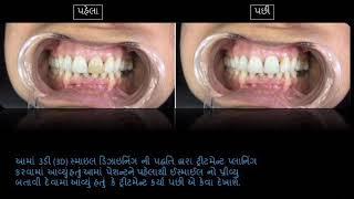 Treatment of dark colour tooth  | Save tooth | Cosmetic Dentistry | Smile Galleria