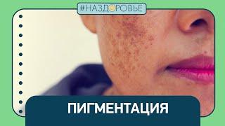 #НАЗДОРОВЬЕ: пигментация