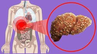 Liver Fibrosis: Stages And Symptoms