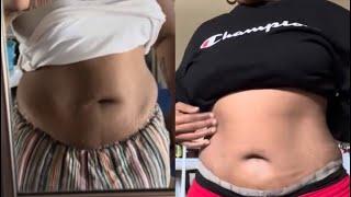 results of the mini tummy tuck/panniculecromy| what you need to know before and after surgery!