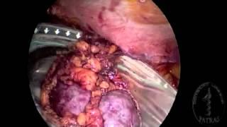 Transvaginal Nephrectomy - Specimen extraction