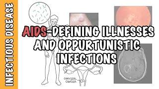 Opportunistic Infections and AIDS-defining illnesses - CD4+ cell count, malignancy, treatment