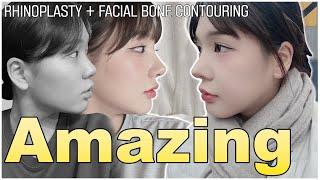 Rhinoplasty + Facial Bone Contouring | Before & After | AB Plastic Surgery