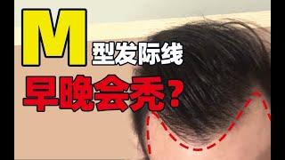 【男士脱发】M型发际线都是遗传导致？M型发际线治疗方法有哪些？丨植发医生徐鲁