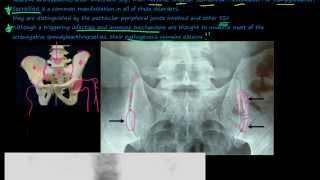 96P Introduction to the Seronegative Spondyloarthropathies