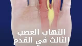 التهاب العصب الثالث في القدم Morton's Neuroma