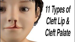 11 Types of Cleft Lip and Cleft Palate