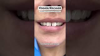 🫦Flowable Injection Technique by Dr. Boeddinghaus #flowableinjection #zahnarzt #schönezähne #veneer