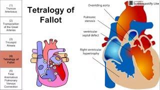 Cyanotic Congenital Heart Diseases