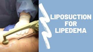 Liposuction for Lipedema Procedure Breakdown