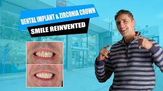 Ignite Your Smile with a Groundbreaking Dental Implant and Zirconia Crown Transformation!