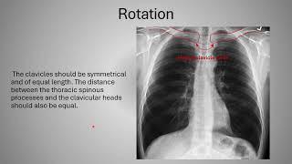 Chest X ray   NAC OSCE best course https://www.mededucanada.com/nac-osce-course-mccqe2-capbc-cex