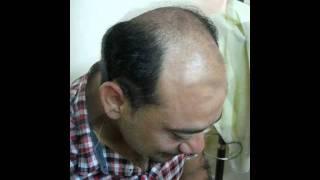 UK Hair Transplant Patient by Dr M jawad Chaudhry,Gujrat Hair Transplant