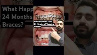 What Happens After 24 Months of Wearing Braces?#dentist #braces #orthodontist #dentistry