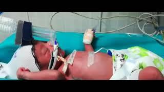 Newborn Respiratory Distress, tachypnea, retractions (baby on nCPAP)