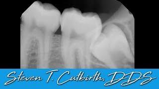 Extracting Impacted Wisdom Teeth - Dental Minute with Steven T. Cutbirth, DDS