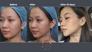 Face reshaping : from short round to elongated narrow face, plus getting rid of double chin
