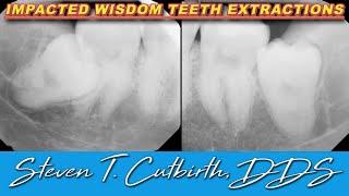 Impacted Wisdom Teeth Extractions - Dental Minute with Steven T. Cutbirth, DDS