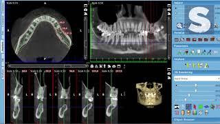 Имплантация зубов и костная пластика – компьютерная томография | стоматологическая клиника Самара