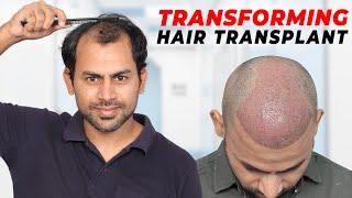 Hair Transplant in Kota | Best Results & Cost of Hair Transplant in Kota