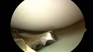 Dr. Troy Layton Lateral Meniscus Tear Surgery Huntsville Alabama