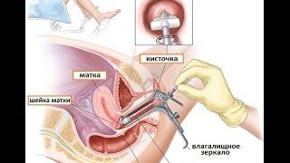 Пап тест: скрининговая диагностика дисплазии шейки матки и предрака