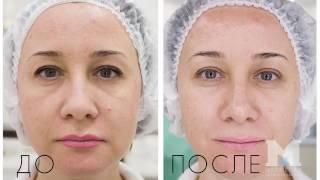 Газожидкостный пилинг Jet Clear в Мармелад.PRO