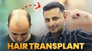 From Bald to Bold: Grade 7 Baldness Conquered  | Hair Transplant Nagpur | New Roots