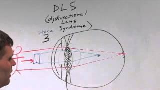 Kugler Vision May 2015 Webinar: Overview of refractive errors and solutions