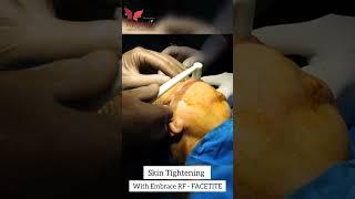 Skin Tightening with Embrace Rf Facetite for Facial Rejuvenation & Youthful Skin