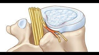 Как плазмолифтинг влияет на грыжу позвоночника?