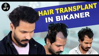 Hair Transplant in Bikaner: Affordable Costs & Superior Results with IFT Hair Science