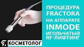 Процедура Fractora на аппарате InMode. Игольчатый RF-лифтинг