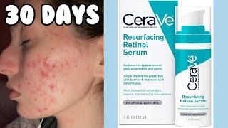 I TRIED THE CERAVE RESURFACING RETINOL SERUM FOR MY ACNE | 1 Month Test