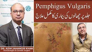 What is Pemphigus Vulgaris? | Skin disease | Happy Patient | Prof. Dr. Azim | Cosmetique