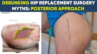 Hip replacement secrets-Revealing the truth !!