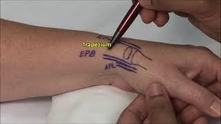 1st CMC Joint Injection