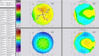 Minimally invasive hyperopic transepi PRK: a novel technique. Kanellopoulos, MD