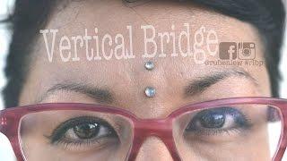 Vertical Bridge procedure