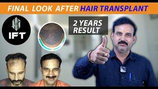 Hair Transplant in Kota at IFT Hair Science | Interlocking FUE Technique for Natural Results