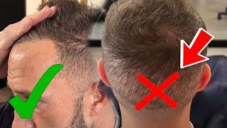 Mike Majlak 8 Months After $2,000 Hair Transplant In Turkey - Smile Hair Clinic